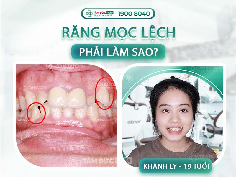 NGUYÊN NHÂN VÀ CÁCH KHẮC PHỤC TÌNH TRẠNG RĂNG NANH MỌC LỆCH