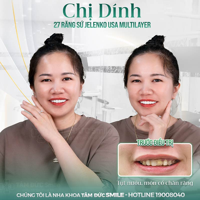 địa chỉ bọc răng sứ đẹp ở Tân Bình