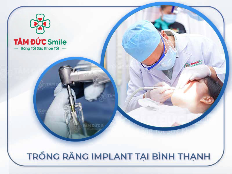 NHA KHOA TÂM ĐỨC SMILE - ĐỊA CHỈ TRỒNG RĂNG IMPLANT UY TÍN TẠI BÌNH THẠNH