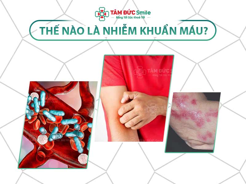 NHIỄM KHUẨN MÁU LÀ GÌ? DẤU HIỆU NHẬN BIẾT VÀ CÁCH PHÒNG TRÁNH