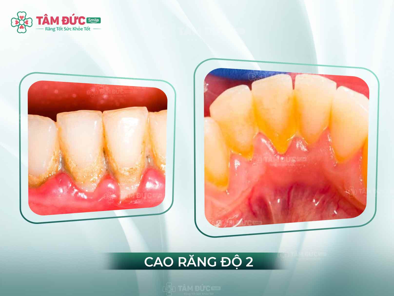 NHỮNG ẢNH HƯỞNG CỦA CAO RĂNG ĐỘ 2 VÀ PHƯƠNG PHÁP XỬ LÝ AN TOÀN, KHÔNG ĐAU