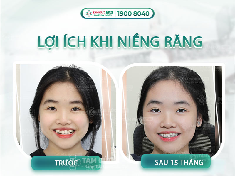 NHỮNG LỢI ÍCH TỪ VIỆC NIỀNG RĂNG - CHỈNH NHA SẼ KHIẾN BẠN BẤT NGỜ