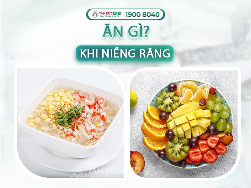 NIỀNG RĂNG ĂN GÌ? 18 THỰC PHẨM NÊN VÀ KHÔNG NÊN ĂN KHI NIỀNG RĂNG