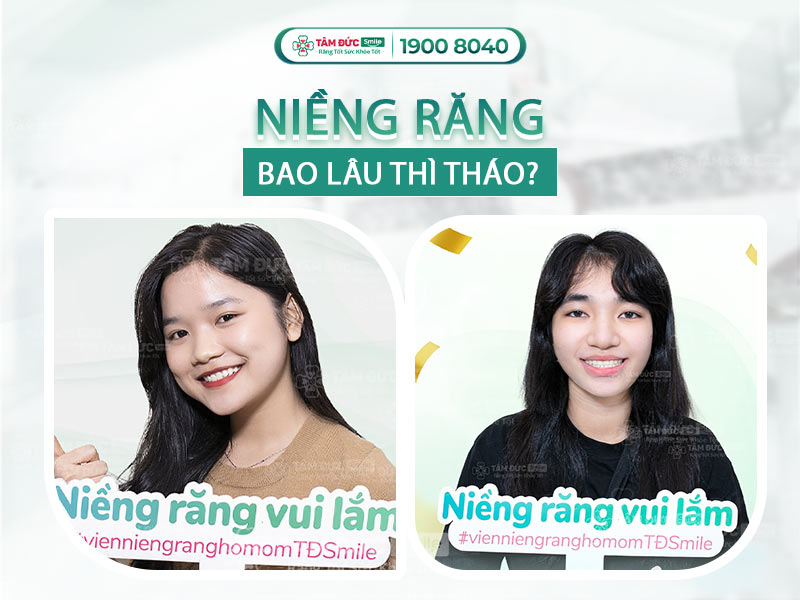 NIỀNG RĂNG BAO LÂU THÌ THÁO ĐƯỢC?