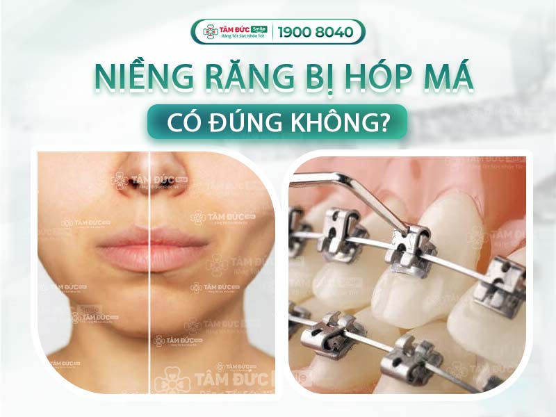 NIỀNG RĂNG BỊ HÓP MÁ: NGUYÊN NHÂN VÀ CÁCH KHẮC PHỤC