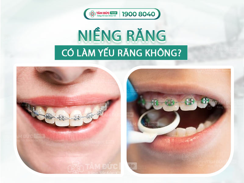 NIỀNG RĂNG CÓ LÀM CHO RĂNG YẾU ĐI HAY KHÔNG? CÁC PHƯƠNG ÁN KHẮC PHỤC