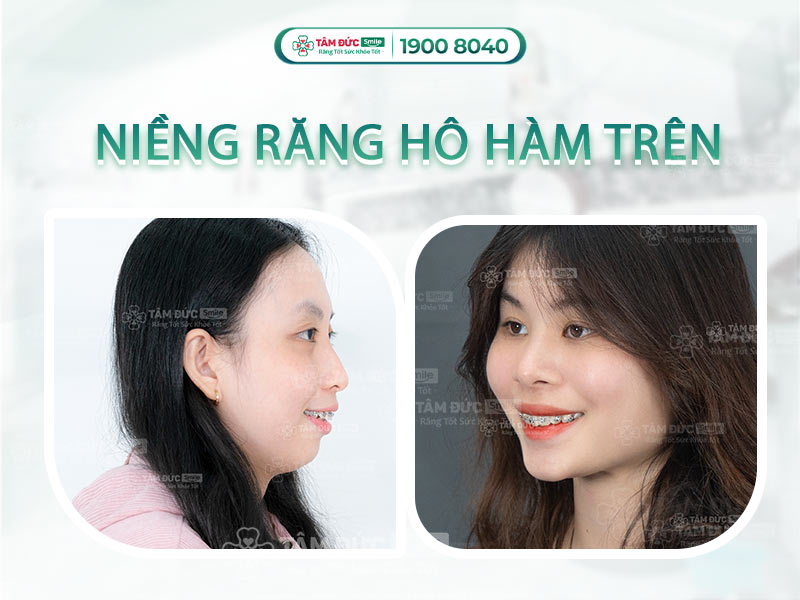 NIỀNG RĂNG HÔ HÀM TRÊN MỚI NHẤT 2025