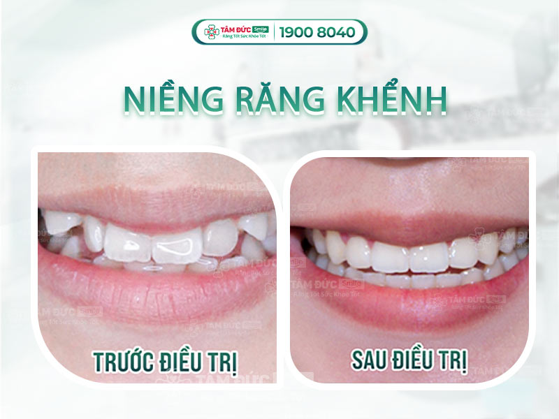 NIỀNG RĂNG KHỂNH CÓ NÊN HAY KHÔNG?