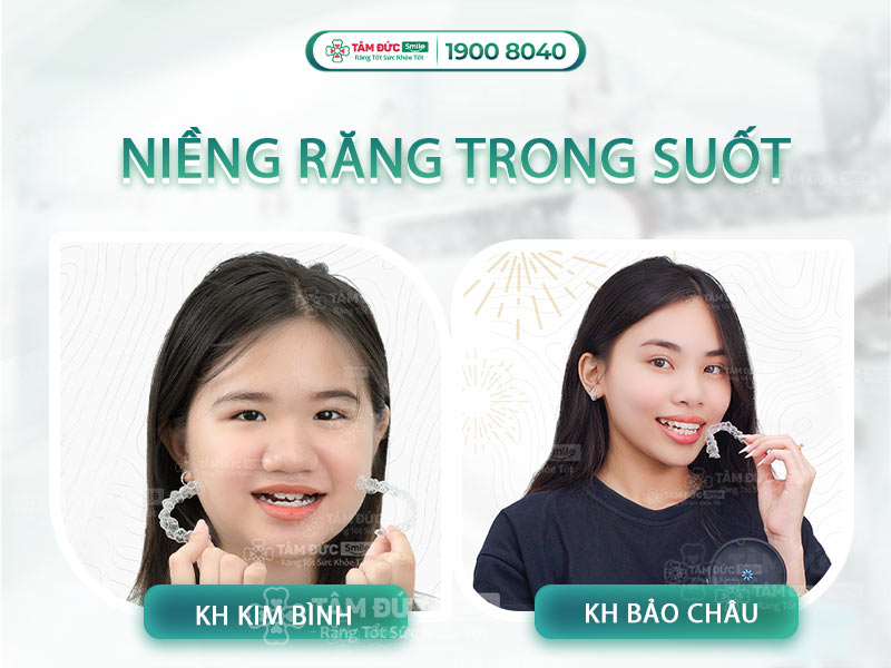 NIỀNG RĂNG KHÔNG MẮC CÀI THẨM MỸ CAO