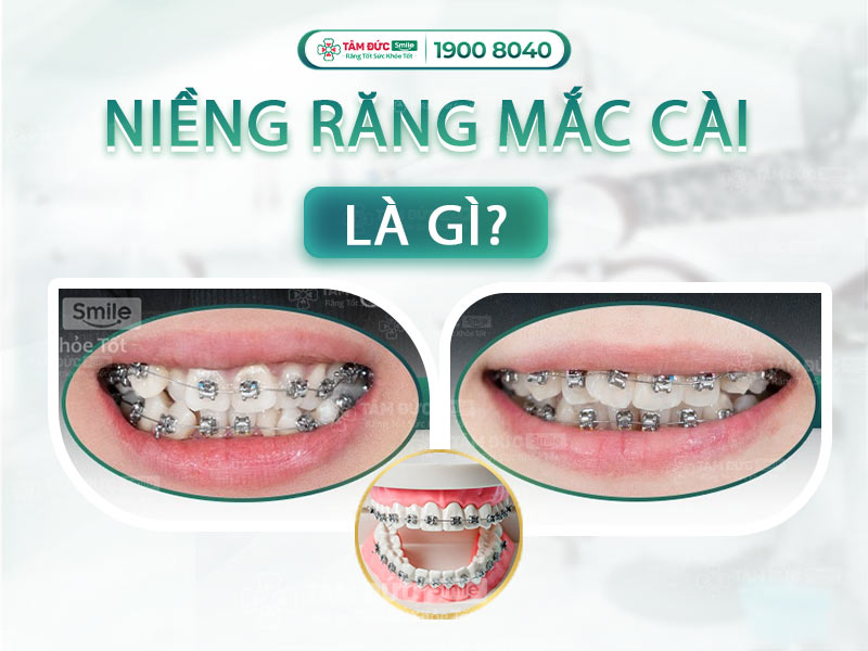 NIỀNG RĂNG MẮC CÀI LÀ GÌ? NHỮNG LOẠI MẮC CÀI TỐT NHẤT HIỆN NAY