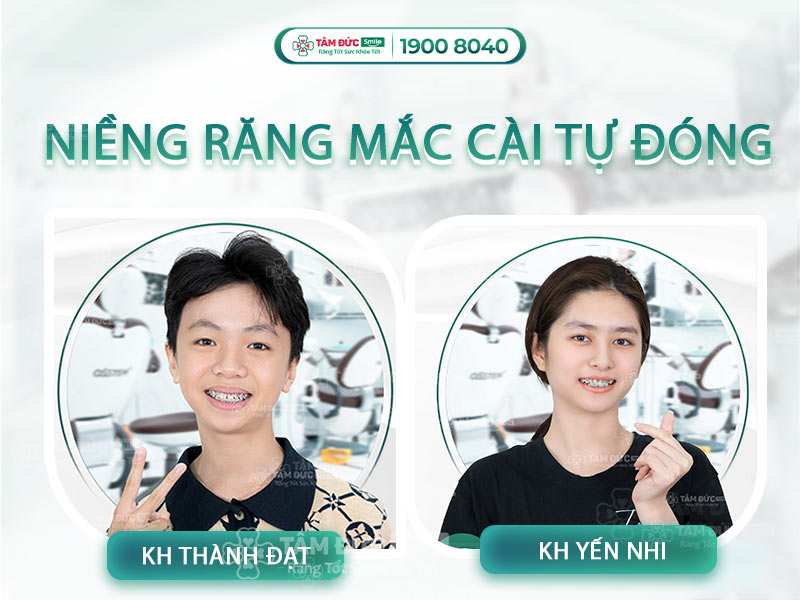 NIỀNG RĂNG MẮC CÀI TỰ ĐÓNG GIẢI PHÁP CHO HÀM RĂNG ĐỀU ĐẸP