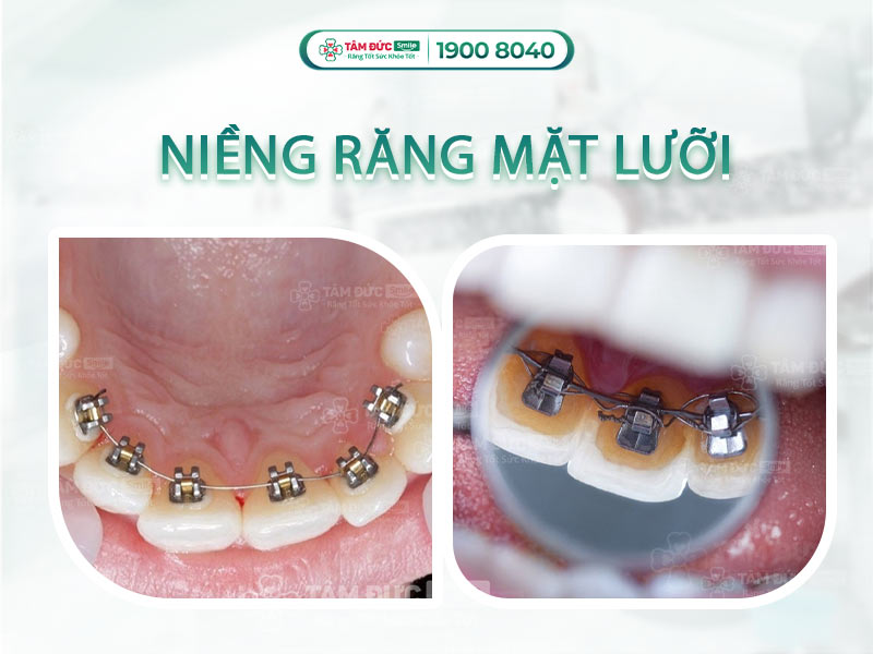 NIỀNG RĂNG MẶT LƯỠI AN TOÀN VÀ THẨM MỸ CAO 