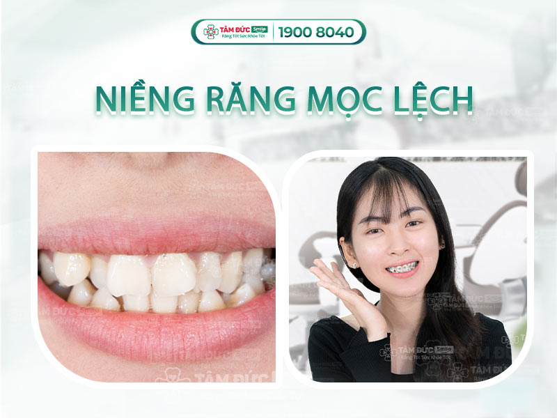 NIỀNG RĂNG MỌC LỆCH CÁCH KHẮC PHỤC HIỆU QUẢ NHẤT