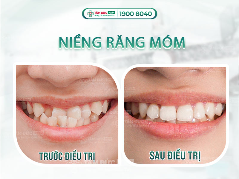 NIỀNG RĂNG MÓM - KHẮC PHỤC MÓM HIỆU QUẢ, DUY TRÌ TRỌN ĐỜI