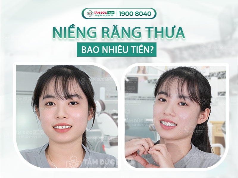 NIỀNG RĂNG THƯA, HÔ GIÁ RẺ MỚI NHẤT 2025