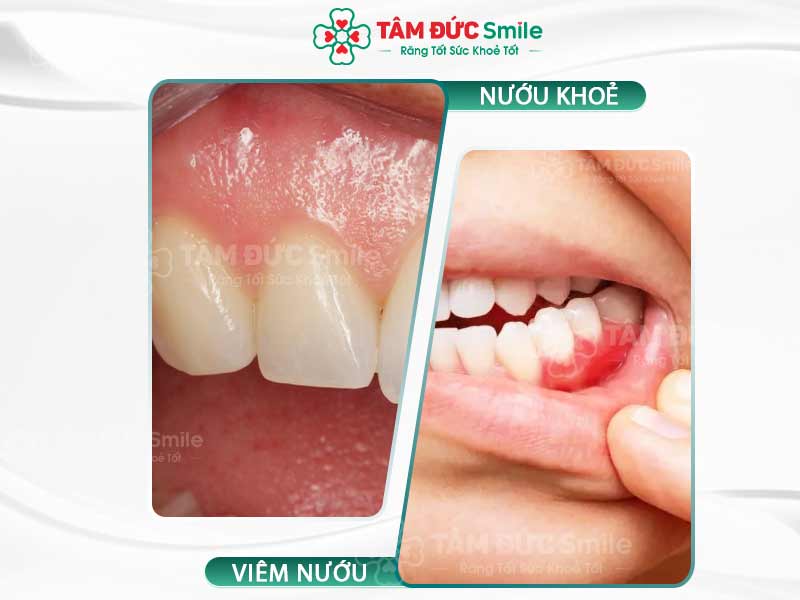 NƯỚU RĂNG BÌNH THƯỜNG TRÔNG NHƯ THẾ NÀO? CÁCH DUY TRÌ NƯỚU RĂNG KHỎE MẠNH