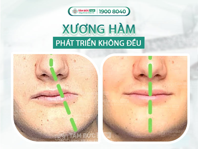 PHẢI LÀM GÌ KHI XƯƠNG HÀM PHÁT TRIỂN KHÔNG ĐỀU? NGUYÊN NHÂN VÀ GIẢI PHÁP KHẮC PHỤC HIỆU QUẢ