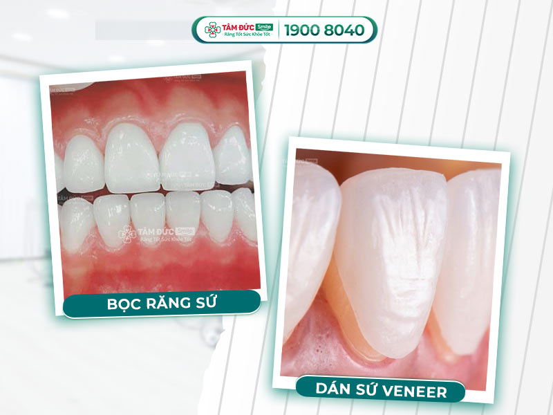 PHÂN BIỆT BỌC SỨ VÀ DÁN SỨ VENEER THẨM MỸ