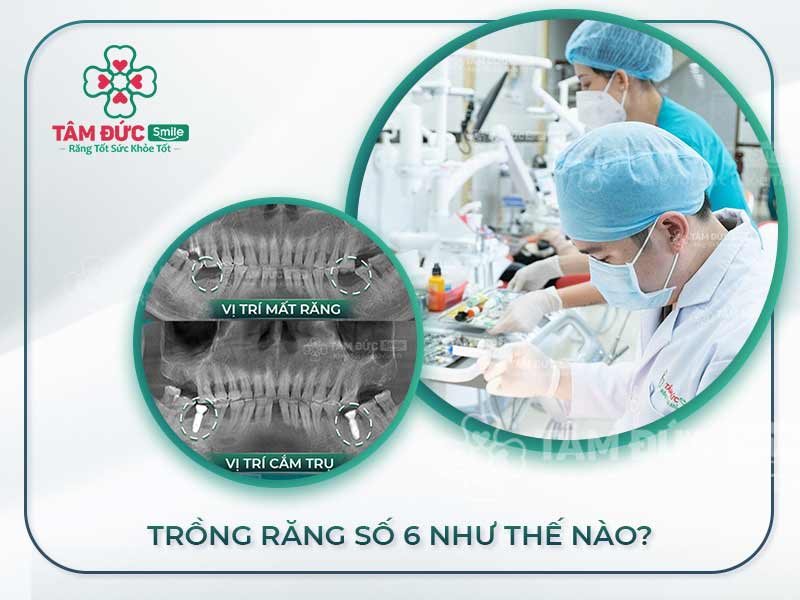 MẤT RĂNG SỐ 6 PHỤC HÌNH BẰNG CÁCH NÀO HIỆU QUẢ NHẤT HIỆN NAY