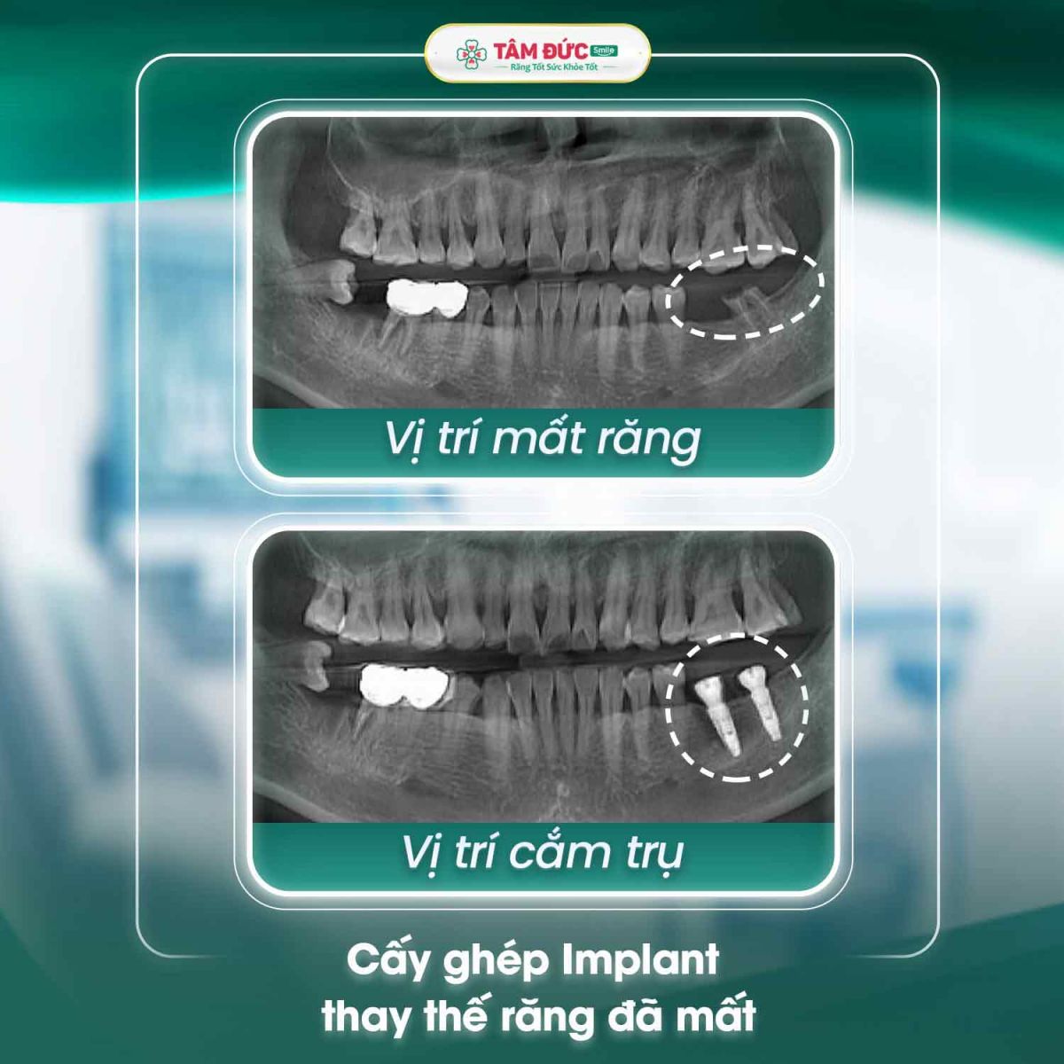 phim x-quang của khách hàng bị mất răng số 6