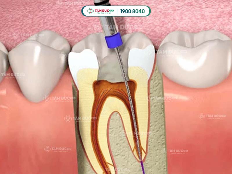 quy trình lấy tuỷ răng chuẩn y khoa