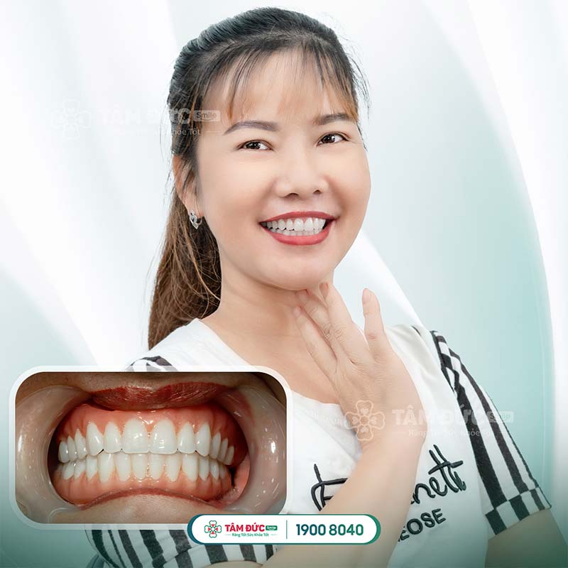 khách hàng bọc răng sứ tại nha khoa Tâm Đức Smile