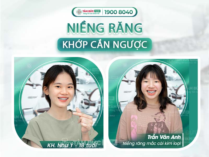 TOP 3 PHƯƠNG PHÁP NIỀNG RĂNG KHỚP CẮN NGƯỢC HIỆU QUẢ NHẤT HIỆN NAY