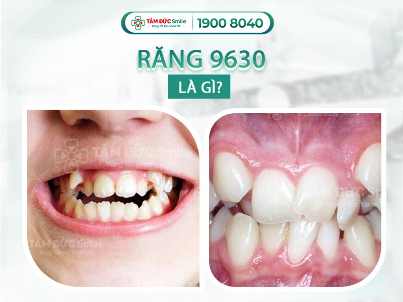 RĂNG 9630 LÀ GÌ? CÓ ẢNH HƯỞNG GÌ KHÔNG? CÓ CẦN CHỮA TRỊ KHÔNG?