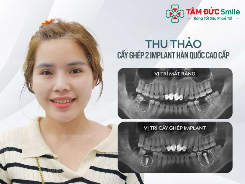 răng bể nhiều có trám được không