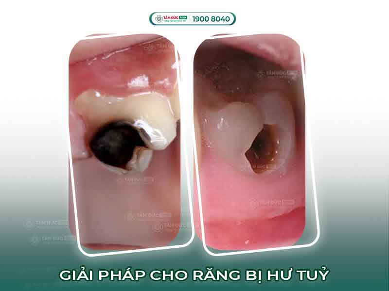 RĂNG BỊ HƯ TỦY PHẢI LÀM SAO? PHƯƠNG PHÁP TRỊ HƯ TỦY HIỆU QUẢ, AN TOÀN