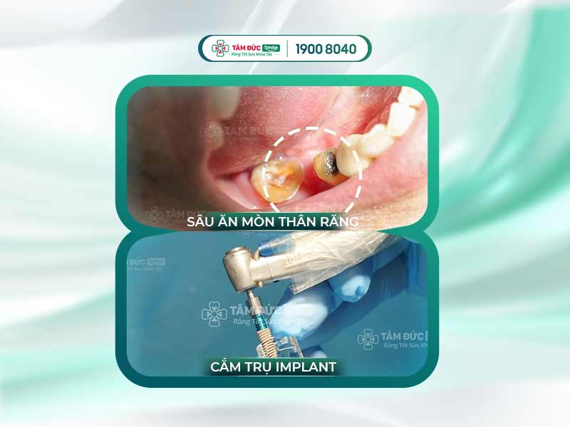 RĂNG BỊ SÂU ĂN MÒN HẾT CÓ GIỮ ĐƯỢC KHÔNG? CÓ NÊN TRỒNG IMPLANT KHÔNG?