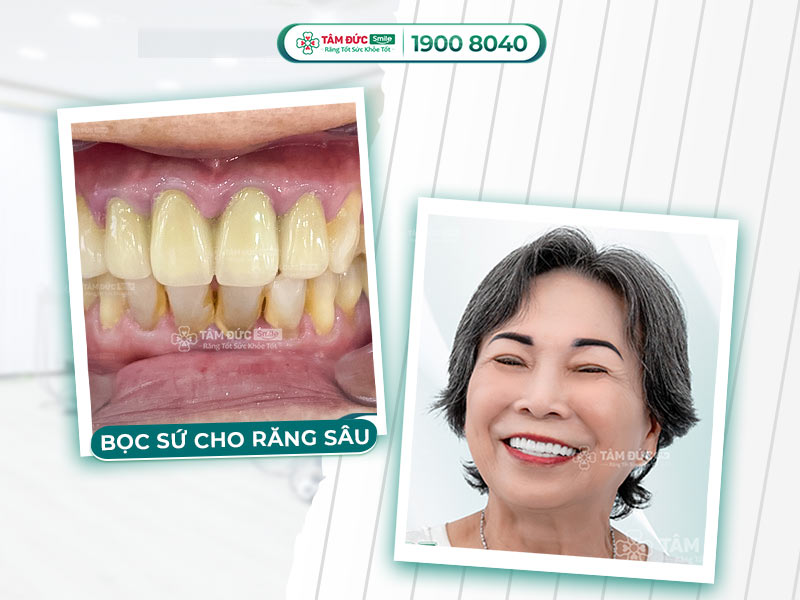 RĂNG BỊ SÂU CÓ BỌC RĂNG SỨ ĐƯỢC HAY KHÔNG