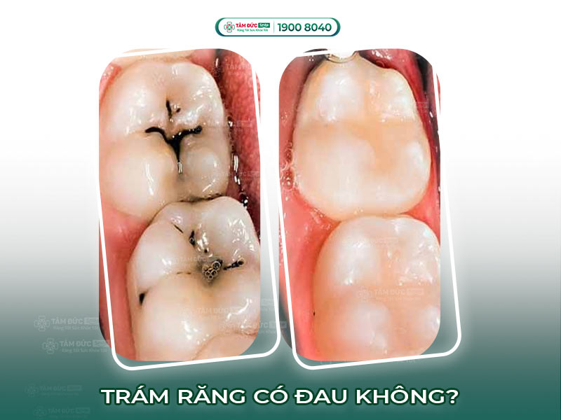  RĂNG BỊ SÂU TRÁM (HÀN) CÓ ĐAU KHÔNG? CÓ SÂU LẠI KHÔNG?