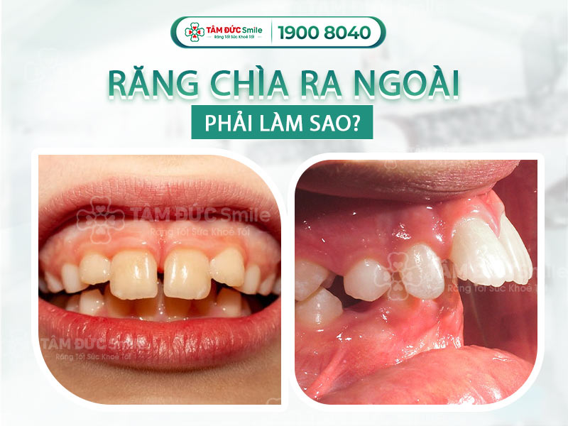 RĂNG CHÌA RA NGOÀI PHẢI LÀM SAO? CÁCH KHẮC PHỤC HIỆU QUẢ