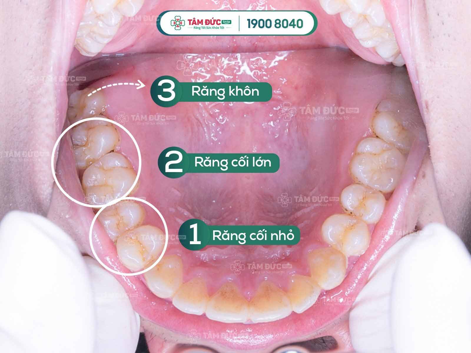 RĂNG CỐI LÀ GÌ? RĂNG CỐI CÓ THAY KHÔNG VÀ 5 GIẢI ĐÁP THÚ VỊ