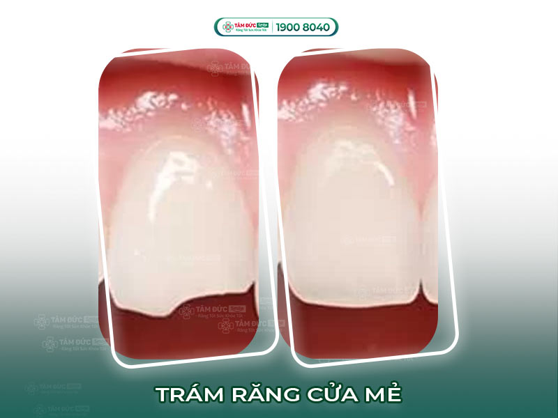 RĂNG CỬA BỊ MẺ - NÊN TRÁM HAY BỌC SỨ?