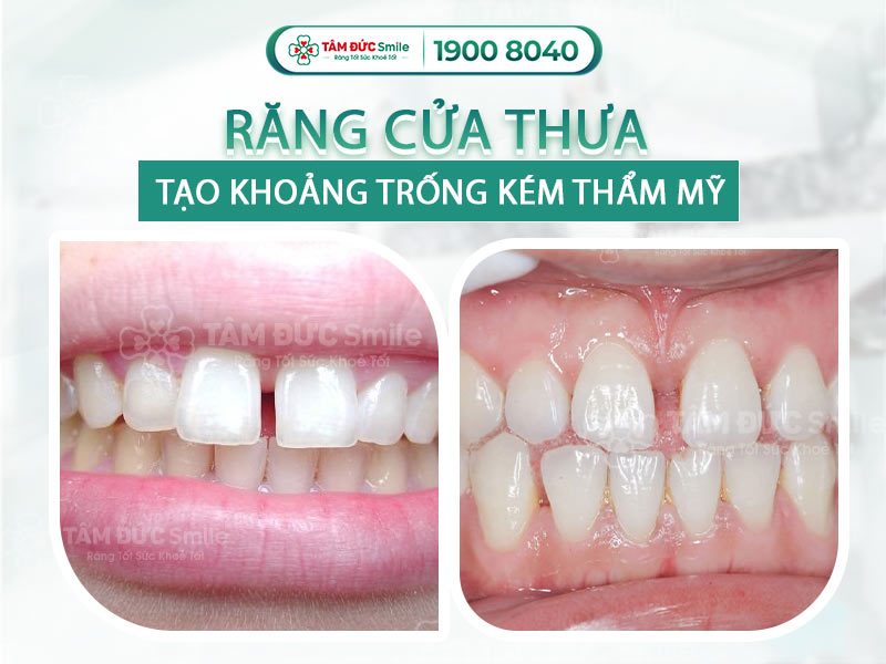 RĂNG CỬA THƯA TƯỚNG SỐ SƯỚNG HAY KHỔ? CÁCH KHẮC PHỤC THƯA RĂNG CỬA