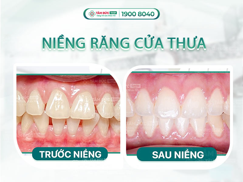 RĂNG CỬA THƯA VÀ CÁCH KHẮC PHỤC TỐI ƯU NHẤT