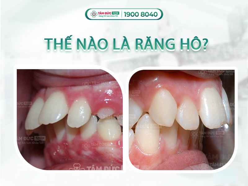 RĂNG HÔ LÀ GÌ ? PHƯƠNG PHÁP KHẮC PHỤC RĂNG HÔ HIỆU QUẢ