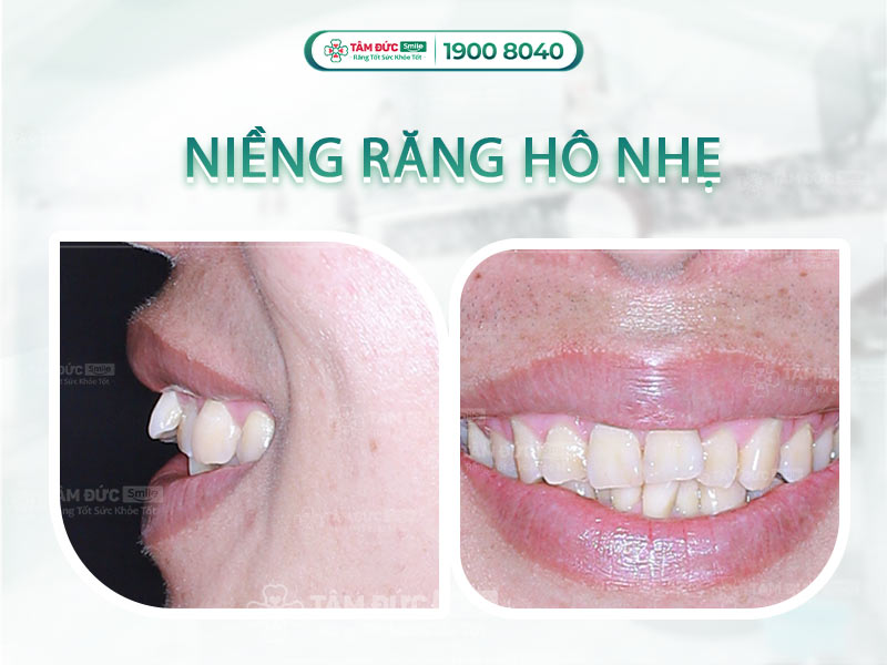 RĂNG HÔ NHẸ CÓ NÊN NIỀNG RĂNG HAY KHÔNG?