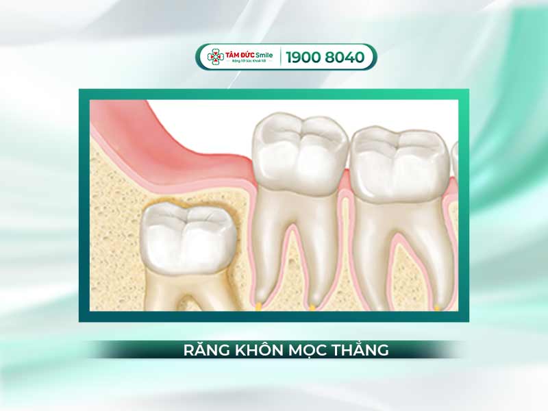 RĂNG KHÔN MỌC THẲNG CÓ CẦN NHỔ BỎ KHÔNG? NHỔ CÓ ĐAU KHÔNG?