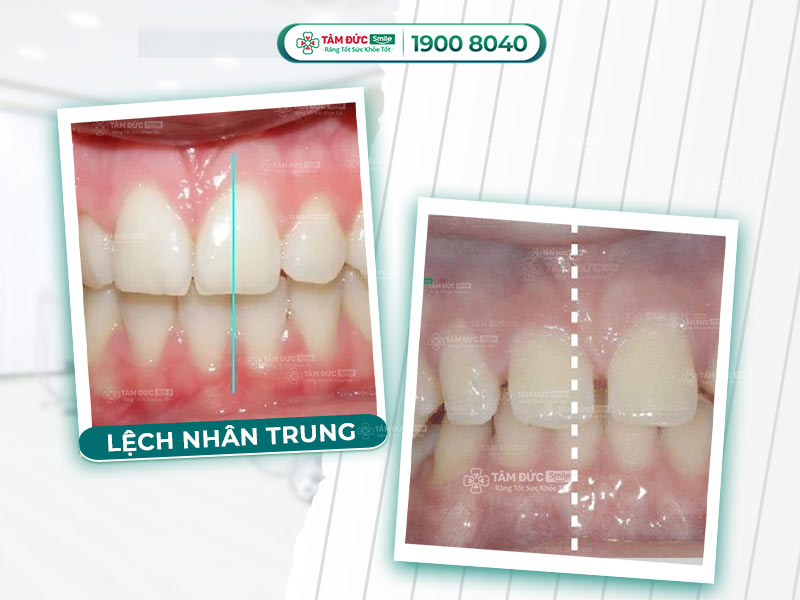 RĂNG LỆCH NHÂN TRUNG: ẢNH HƯỞNG VÀ CÁCH KHẮC PHỤC NHANH, AN TOÀN