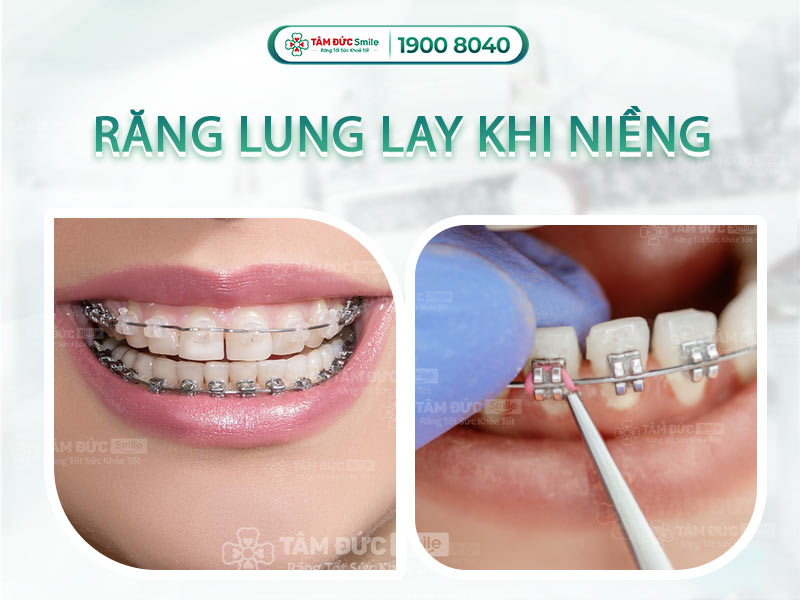 RĂNG LUNG LAY KHI NIỀNG CÓ GÂY RA ẢNH HƯỞNG GÌ KHÔNG? CÁCH KHẮC PHỤC