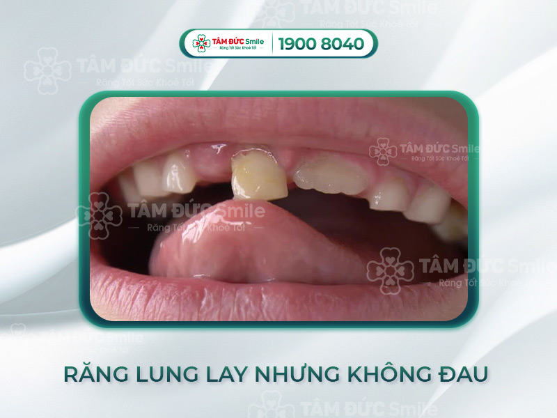 RĂNG LUNG LAY NHƯNG KHÔNG ĐAU LÀ VÌ SAO? CÓ ẢNH HƯỞNG GÌ KHÔNG?