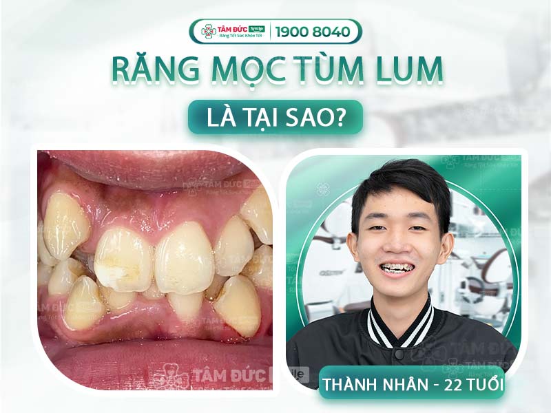 RĂNG MỌC TÙM LUM LÀ DO ĐÂU? CÁCH ĐỂ CÓ HÀM RĂNG ĐỀU ĐẸP