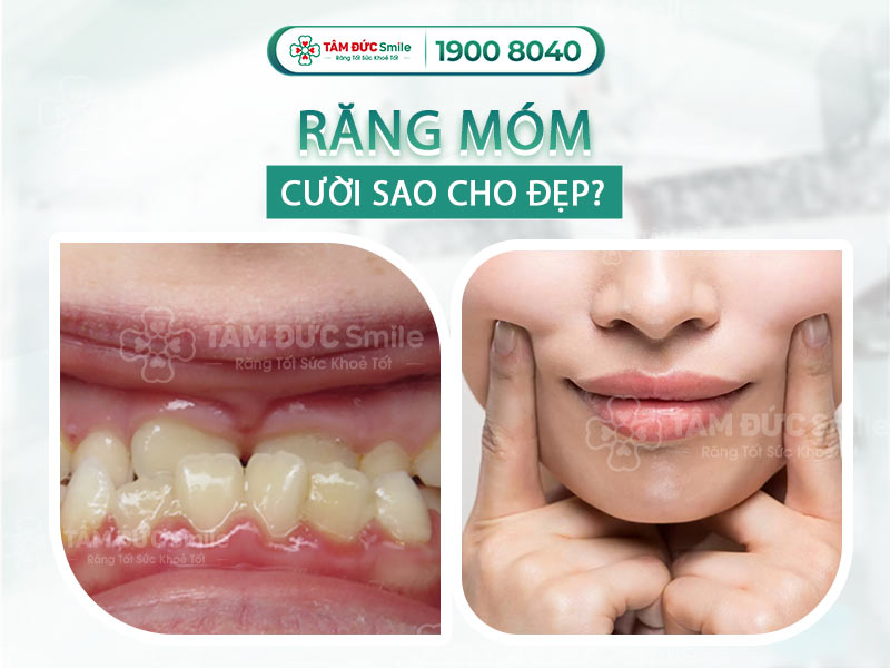 RĂNG MÓM CƯỜI SAO CHO ĐẸP? CÁC PHƯƠNG PHÁP CẢI THIỆN MÓM RĂNG