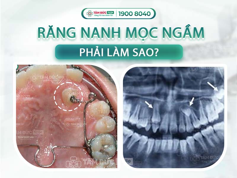 RĂNG NANH MỌC NGẦM NÊN NIỀNG HAY NHỔ? ĐỊA CHỈ CHỮA RĂNG MỌC NGẦM UY TÍN