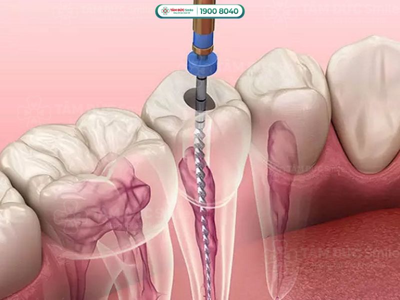 Răng sâu có nên lấy tủy không? Lấy tủy răng có ảnh hưởng gì không