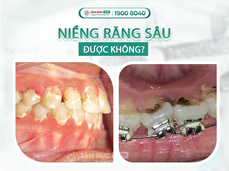 [GIẢI ĐÁP] RĂNG SÂU CÓ NIỀNG ĐƯỢC KHÔNG? BIỆN PHÁP PHÒNG NGỪA SÂU RĂNG KHI CHỈNH NHA