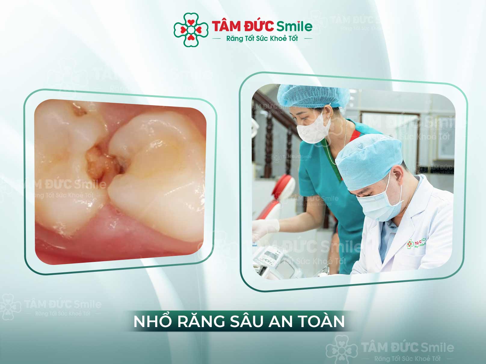 RĂNG SÂU LỒI THỊT CÓ NHỔ ĐƯỢC KHÔNG? NHỔ BỎ CÓ ĐAU KHÔNG?